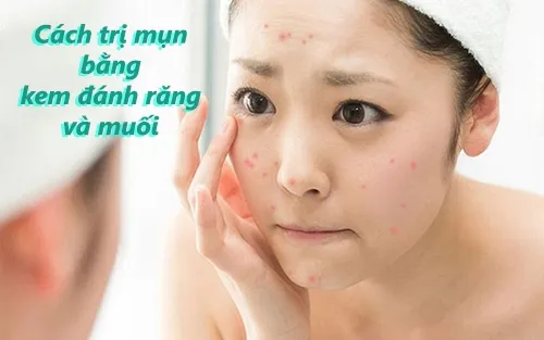 cach20tri20mun20bang20kem20danh20rang20va20muoi cách trị mụn bằng kem đánh răng và muối