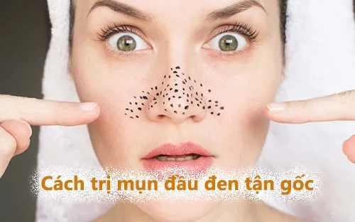 cách trị mụn đầu đen tận gốc tại nhà