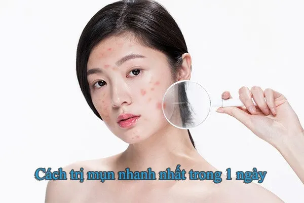 cách trị mụn nhanh nhất trong 1 ngày