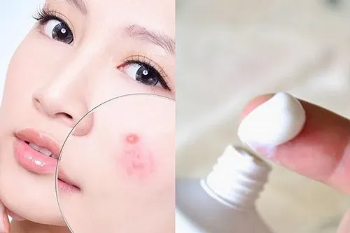 cách trị mụn trong 1 ngày hiệu quả bằng kem đánh răng