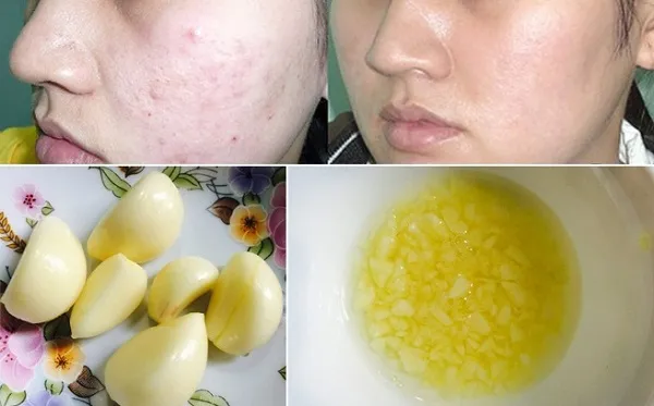 cách trị mụn trong 1 ngày bằng tỏi