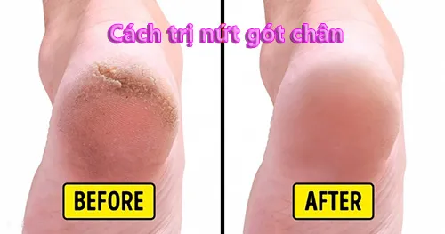 cach tri nut got chan