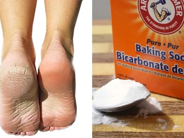 bằng baking soda