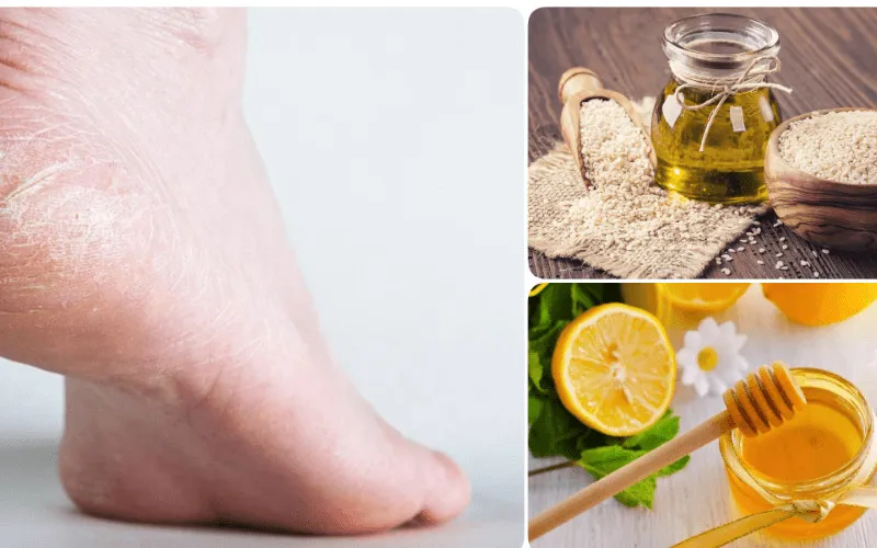 trị nứt gót chân bằng mật ong hiệu quả