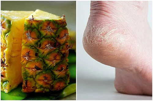 trị nứt gót chân hiệu quả bằng vỏ chuối