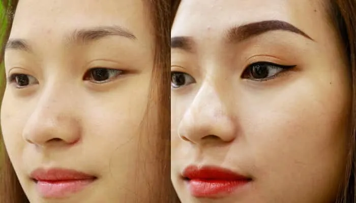 những lưu ý khi phun mí mở tròng là gì