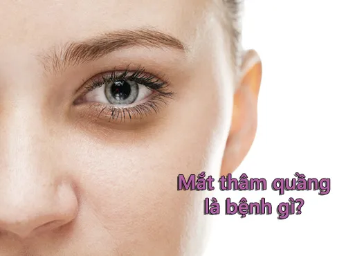 mắt thâm quầng là bệnh gì