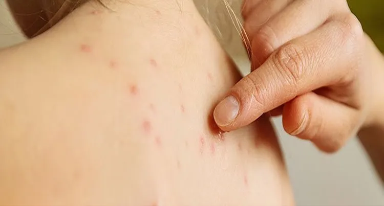 sẹo thủy đậu bao lâu thì hết và cách điều trị