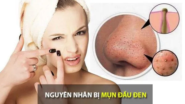 nguyên nhân hình thành mụn đầu đen