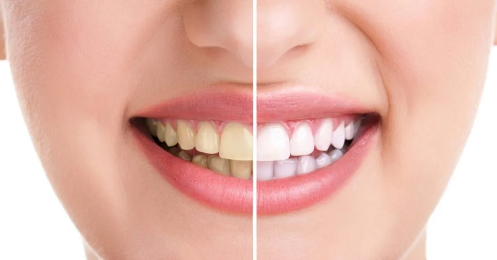 những lưu ý về cách làm trắng răng bằng chanh
