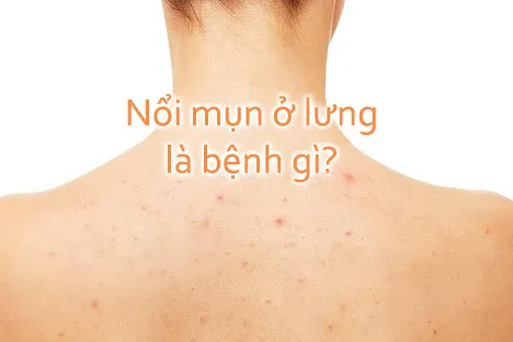 nổi mụn ở lưng là bệnh gì