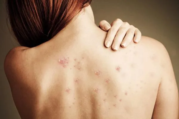 nổi mụn ở lưng là bệnh viêm nang lông