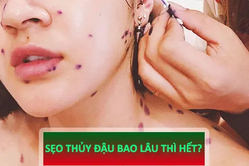 sẹo thủy đậu bao lâu thì hết