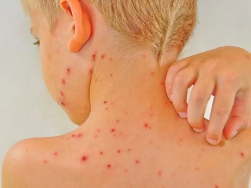 sẹo thủy đậy bao lâu thì hết và cách làm mờ sẹo