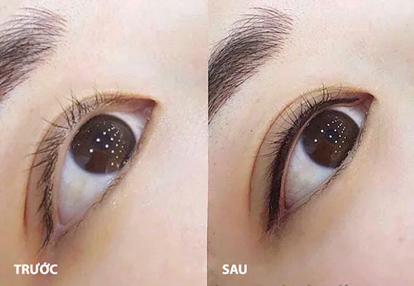 ưu điểm của phun mí mở tròng là gì